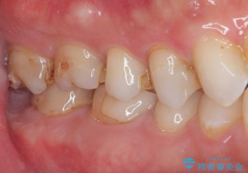 セラミックの詰め物が欠けたのでやり替えたい オールセラミッククラウンの治療前