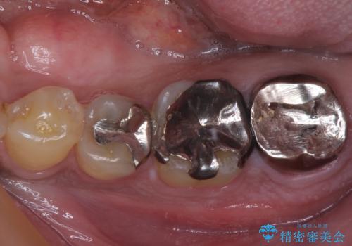 奥歯が痛い 破折した奥歯のインプラント治療の症例 治療前