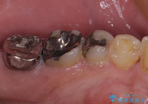 奥歯が痛い 破折した奥歯のインプラント治療の治療前