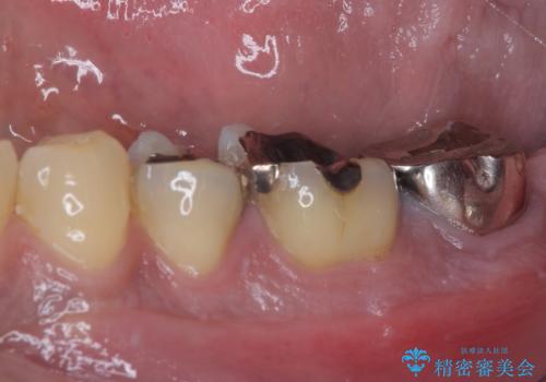 奥歯が痛い 破折した奥歯のインプラント治療の治療前