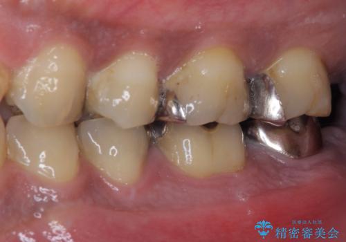 奥歯が痛い 破折した奥歯のインプラント治療の治療前