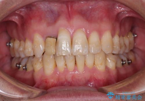 前歯のデコボコを治したい インビザラインによる矯正治療の治療中