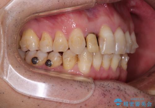 前歯のデコボコを治したい インビザラインによる矯正治療の治療中