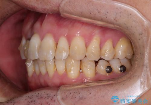 前歯のデコボコを治したい インビザラインによる矯正治療の治療中