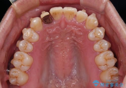 前歯のデコボコを治したい インビザラインによる矯正治療の治療中