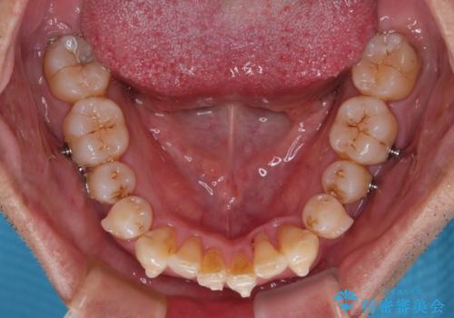 前歯のデコボコを治したい インビザラインによる矯正治療の治療中