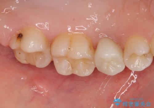 虫歯になった気がするので治療したい ゴールドインレー修復の治療前