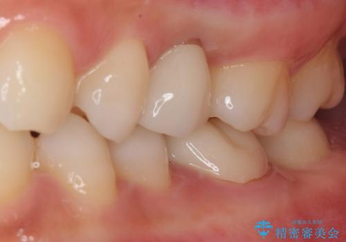 虫歯になった気がするので治療したい ゴールドインレー修復の治療前