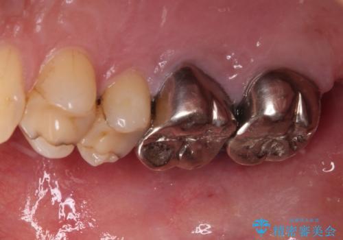 目立つ銀歯と欠けてしまった詰め物 オールセラミッククラウンでの補綴治療の治療前