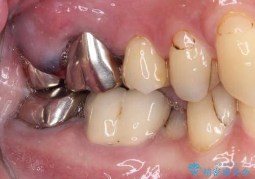 目立つ銀歯と欠けてしまった詰め物 オールセラミッククラウンでの補綴治療の治療前