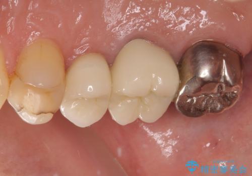 目立つ銀歯と欠けてしまった詰め物 オールセラミッククラウンでの補綴治療の治療後