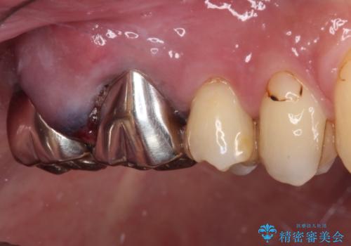 目立つ銀歯と欠けてしまった詰め物 オールセラミッククラウンでの補綴治療の治療前