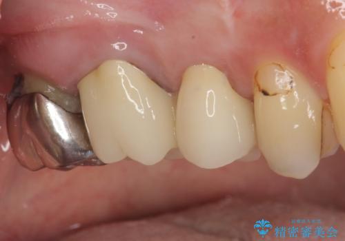 目立つ銀歯と欠けてしまった詰め物 オールセラミッククラウンでの補綴治療の治療後