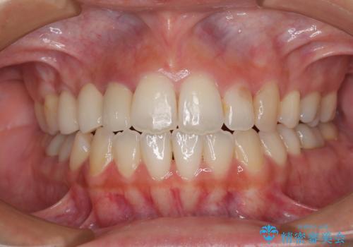 開咬と前突を改善 ワイヤー装置での抜歯矯正