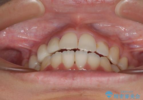 開咬と前突を改善 ワイヤー装置での抜歯矯正の治療後