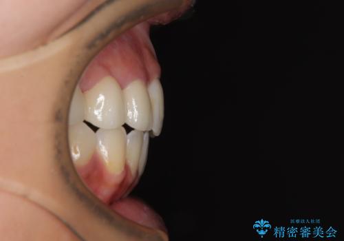 開咬と前突を改善 ワイヤー装置での抜歯矯正の治療後