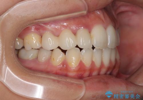 開咬と前突を改善 ワイヤー装置での抜歯矯正の治療後