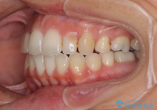 開咬と前突を改善 ワイヤー装置での抜歯矯正の治療後