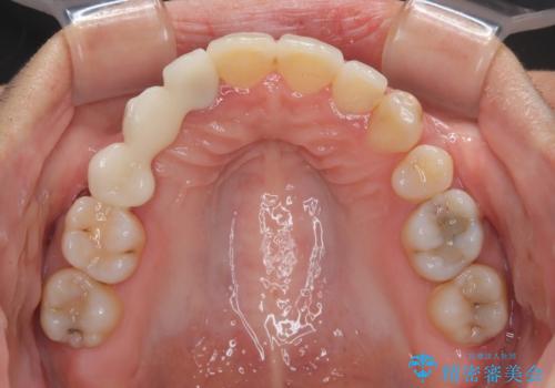 開咬と前突を改善 ワイヤー装置での抜歯矯正の治療後