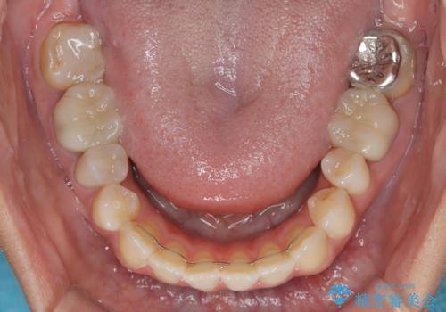 開咬と前突を改善 ワイヤー装置での抜歯矯正の治療後