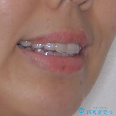 開咬と前突を改善 ワイヤー装置での抜歯矯正の治療後(顔貌)