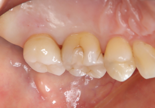 奥歯に歯を入れたい。インプラント治療の治療後