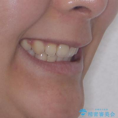 飛び出した前歯と八重歯を改善 ワイヤー装置での抜歯矯正の治療後(顔貌)