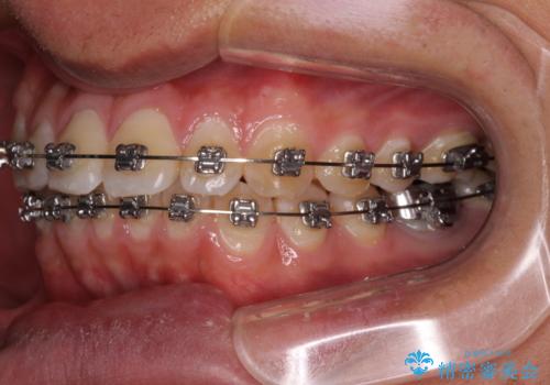 楽してデコボコを治したい ワイヤー矯正治療の治療中