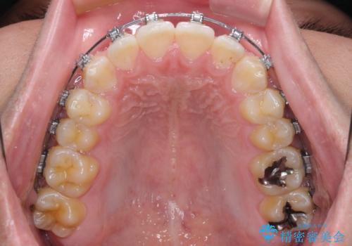 楽してデコボコを治したい ワイヤー矯正治療の治療中