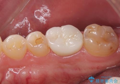 セラミックの詰め物が欠けたのでやり替えたい　オールセラミッククラウンの治療後