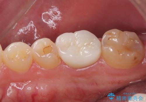 セラミックの詰め物が欠けたのでやり替えたい オールセラミッククラウンの治療後