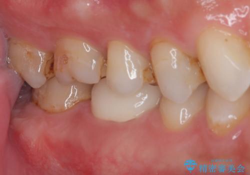 セラミックの詰め物が欠けたのでやり替えたい　オールセラミッククラウンの治療後