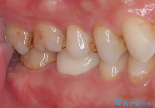 セラミックの詰め物が欠けたのでやり替えたい オールセラミッククラウンの治療後
