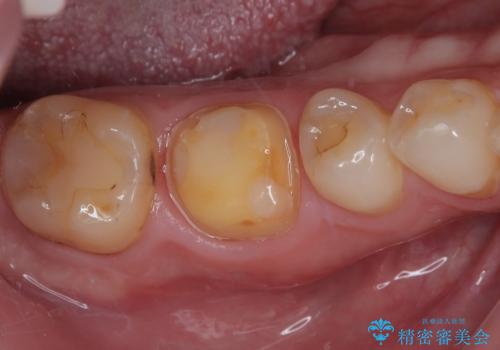 セラミックの詰め物が欠けたのでやり替えたい　オールセラミッククラウンの治療中