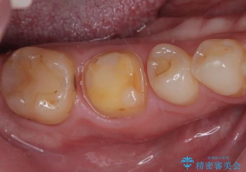 セラミックの詰め物が欠けたのでやり替えたい オールセラミッククラウンの治療中