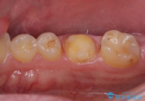 セラミックの詰め物が欠けたのでやり替えたい オールセラミッククラウンの治療中