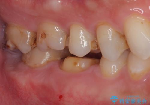 セラミックの詰め物が欠けたのでやり替えたい オールセラミッククラウンの治療中