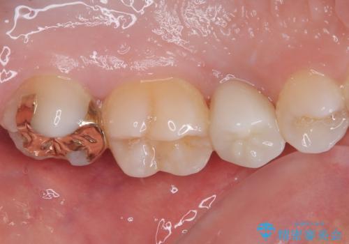 虫歯になった気がするので治療したい ゴールドインレー修復の治療後
