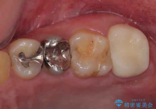 銀歯が何度も外れる オールセラミッククラウンの症例 治療後