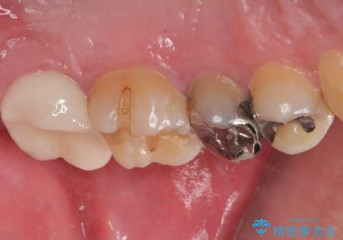 銀歯が何度も外れる オールセラミッククラウンの治療後
