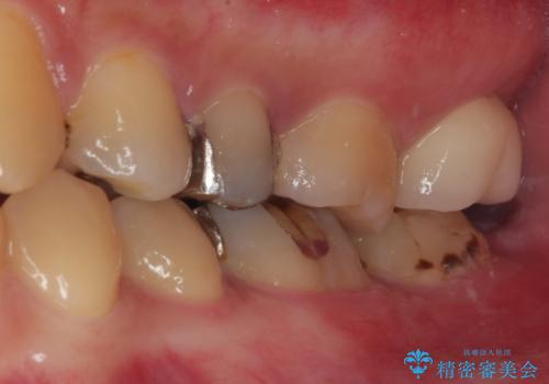 銀歯が何度も外れる　オールセラミッククラウンの治療後
