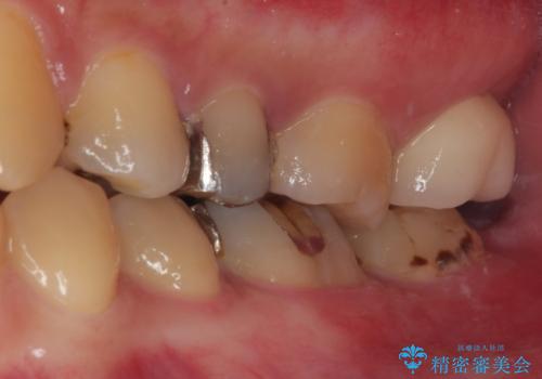 銀歯が何度も外れる オールセラミッククラウンの治療後