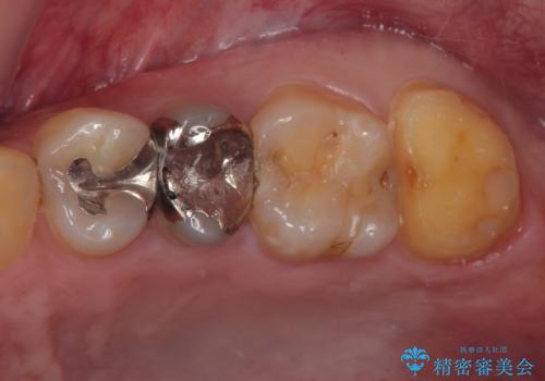銀歯が何度も外れる オールセラミッククラウンの治療中