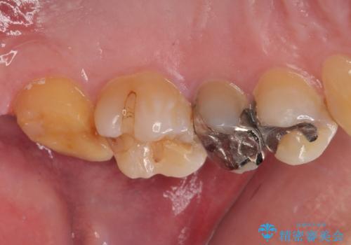 銀歯が何度も外れる オールセラミッククラウンの治療中
