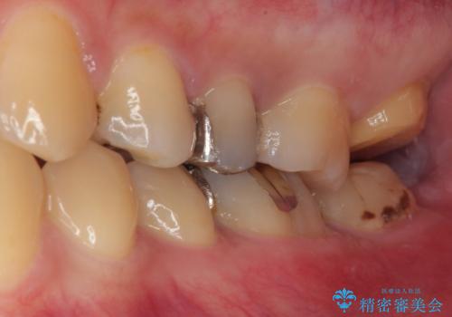 銀歯が何度も外れる　オールセラミッククラウンの治療中
