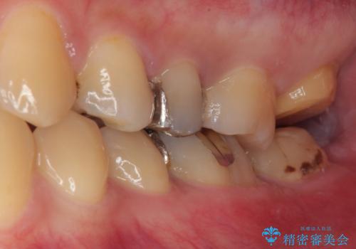 銀歯が何度も外れる オールセラミッククラウンの治療中