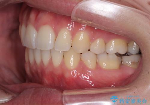 口元が出ているのが気になる。審美装置による抜歯矯正の治療後