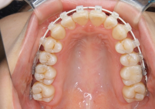 非抜歯、ワイヤーでの矯正治療。歯のがたつき、顎のズレ、出っ歯を治す。インビザラインが使えない方の治療中