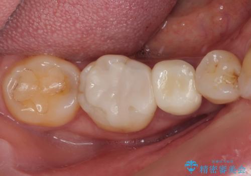 食べ物が引っかかるからやり替えたい　セラミックインレー修復の症例 治療後
