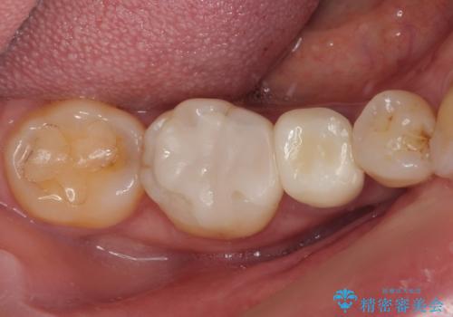 食べ物が引っかかるからやり替えたい セラミックインレー修復の症例 治療後